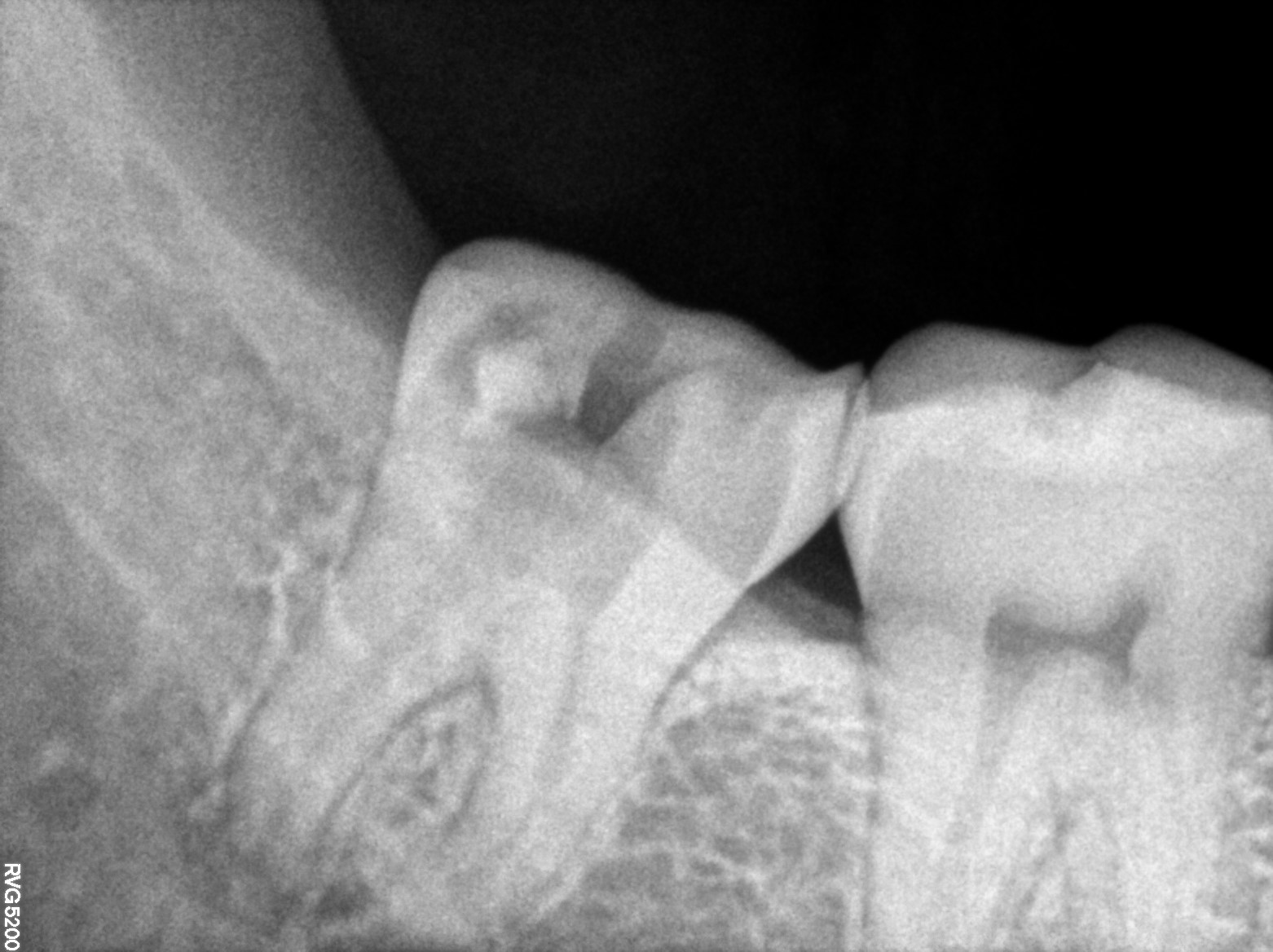 Dental X-ray